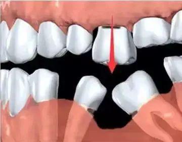守护健康微笑 从认识“掉牙”到科学预防