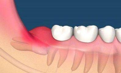 智齿拔除后就万事大吉？警惕“干槽症”及其他术后护理关键